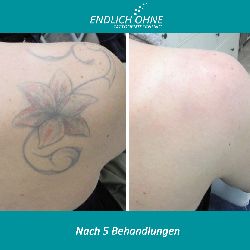 Tattooentfernung